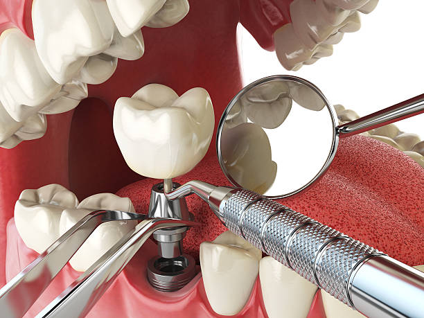 Tooth Infection Emergency Dentist in AL